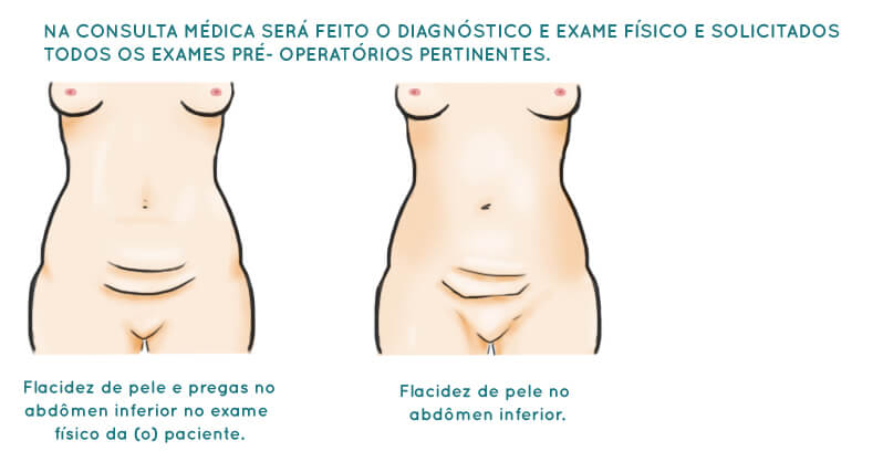 Abdominoplastia (cirugía estética de abdomen) - iMed Medical