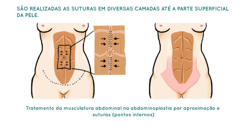 Abdominoplastia