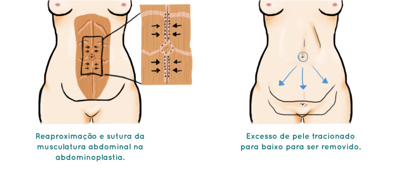 Abdominoplastia