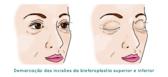 Blefaroplastia