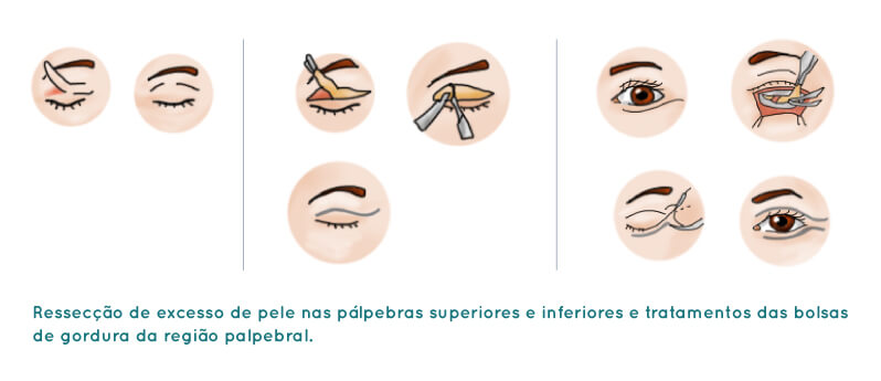 Blefaroplastia