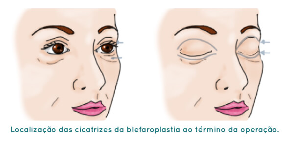 Blefaroplastia