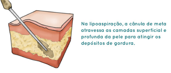 Lipoaspiração