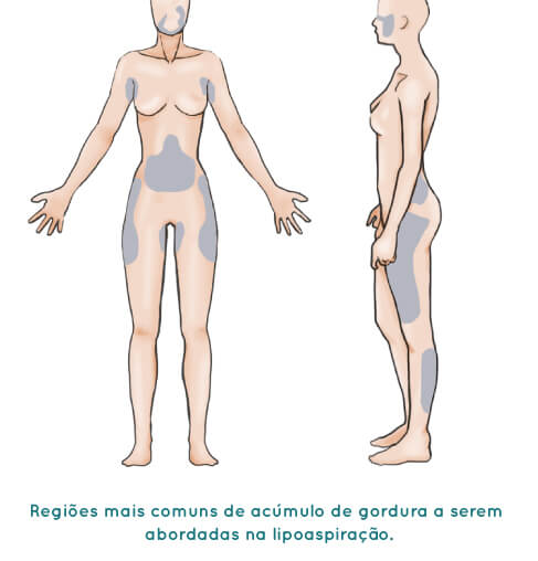 Lipoaspiração