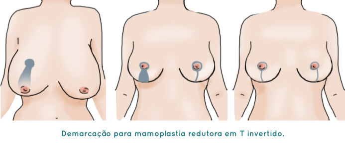 Mamoplastia Redutora