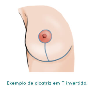 Mamoplastia Redutora