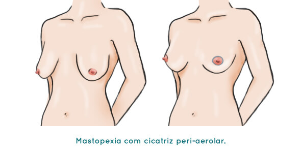 Mastopexia