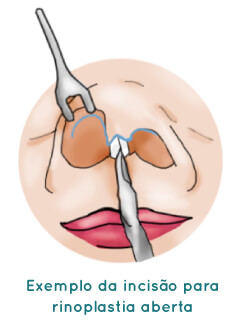 Rinoplastia